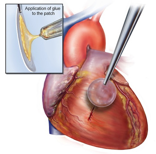 This worm-inspired glue can mend broken hearts