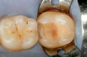 Fig. 2: The prep after removal of caries - 3 modes of a universal adhesive: Part I — self-etch by Jeff Blank, DMD