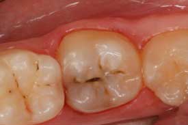 Fig. 1: Extensive caries on No. 30 - 3 modes of a universal adhesive: Part I — self-etch by Jeff Blank, DMD