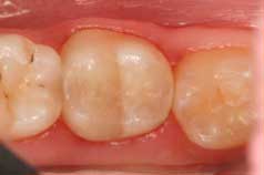 Fig. 5: Immediate view of the completed restoration - The 3 modes of a universal adhesive: Part I — self-etch by Jeff Blank, DMD
