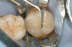 Fig. 4: The cavity form was filled with Filtek Supreme Ultra Universal Restorative - 3 modes of a universal adhesive: Part I — self-etch by Jeff Blank, DMD